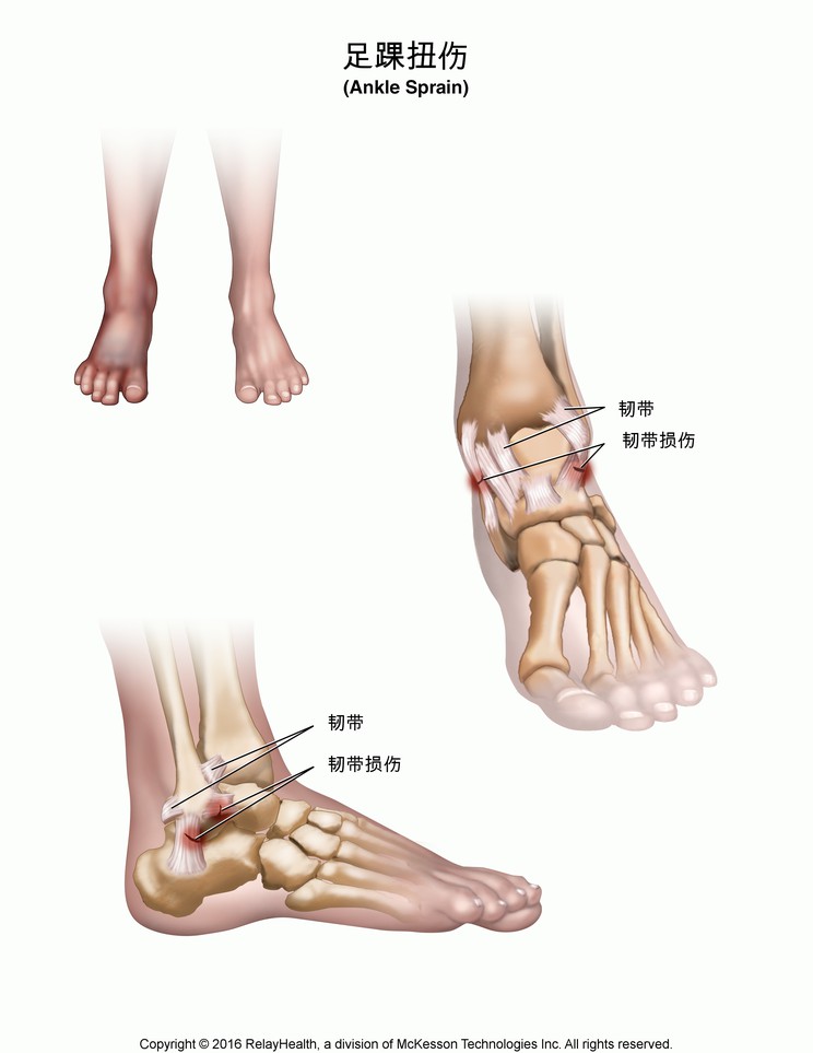 Ankle Sprain: Illustration