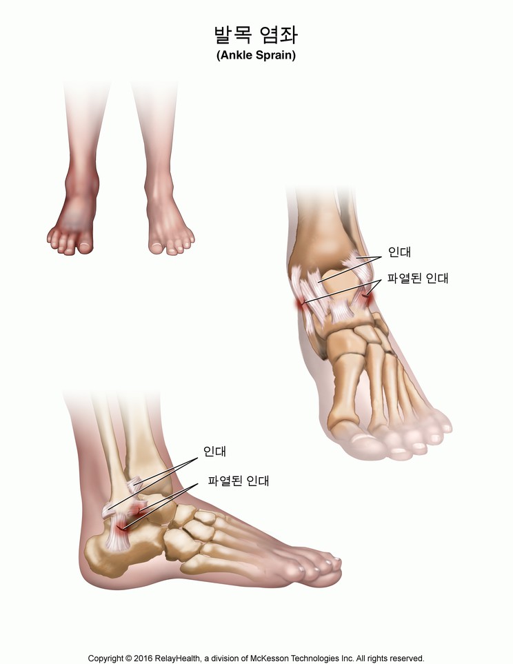 Ankle Sprain: Illustration