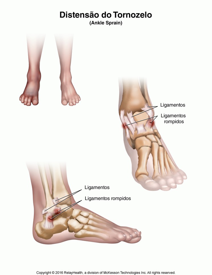 Ankle Sprain: Illustration
