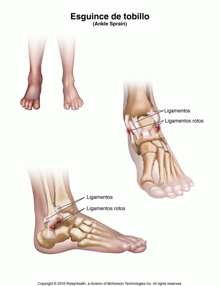Ankle Sprain: Illustration