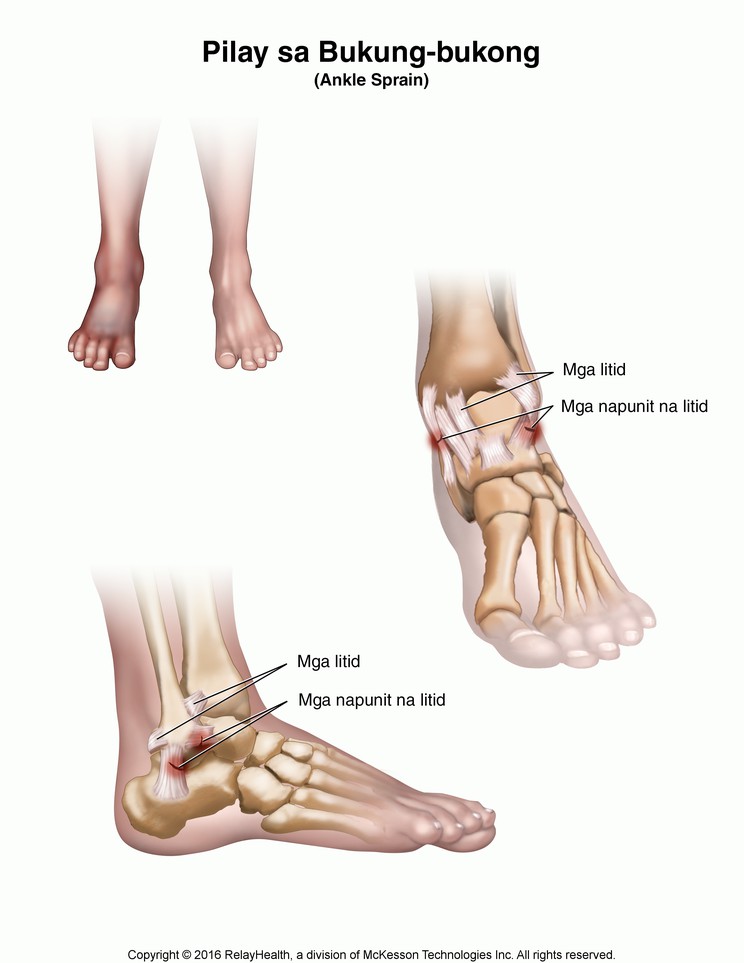 Ankle Sprain: Illustration