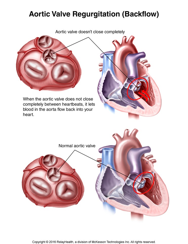 Aortic Valve Regurgitation (Backflow): Illustration