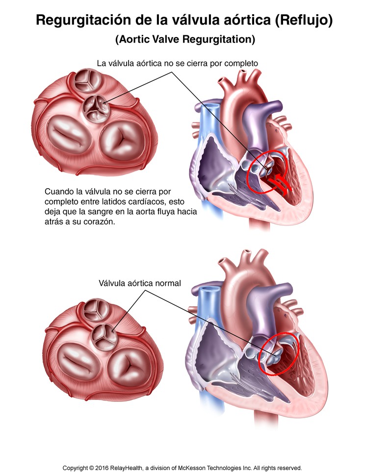 Aortic Valve Regurgitation (Backflow): Illustration