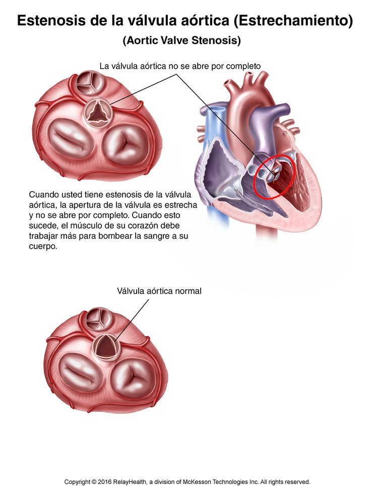 Aortic Valve Stenosis (Narrowing): Illustration