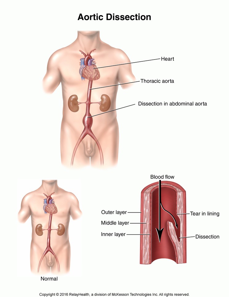 Aortic Dissection: Illustration