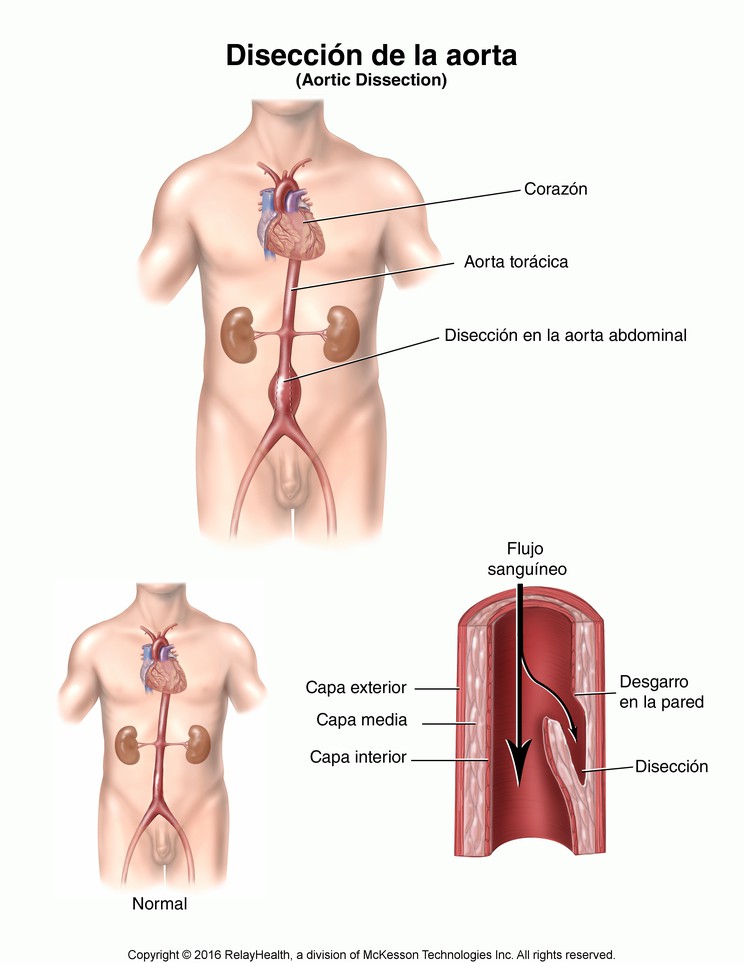Aortic Dissection: Illustration