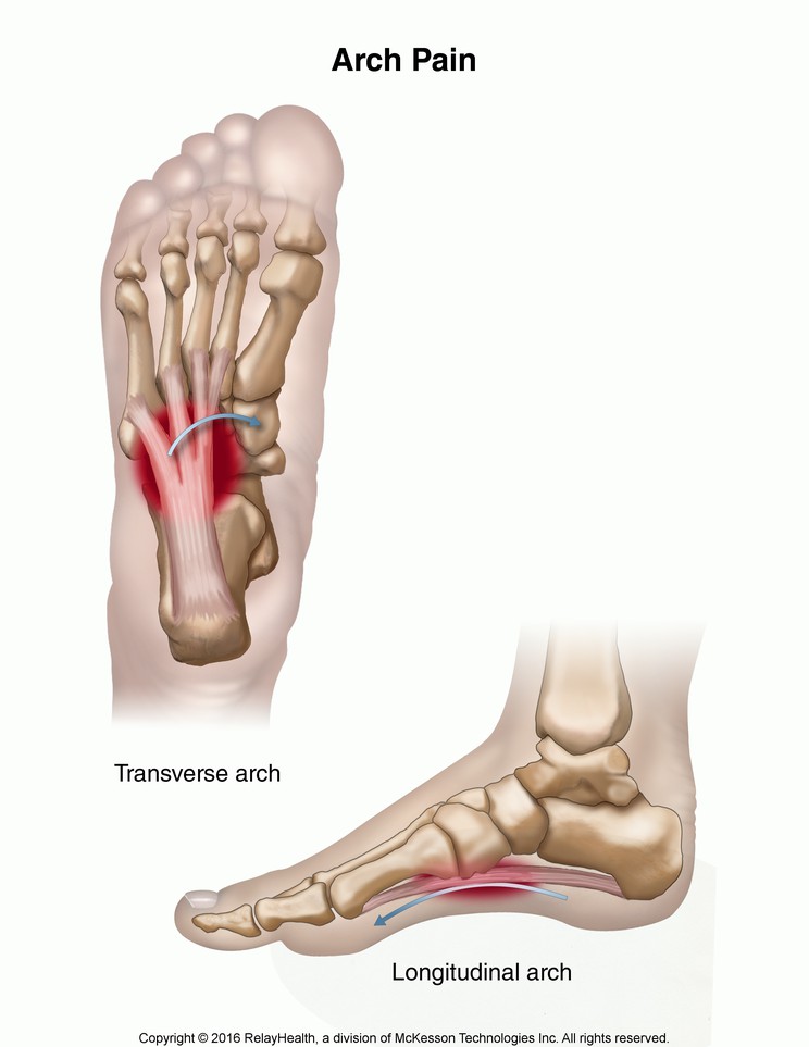Arch Pain: Illustration