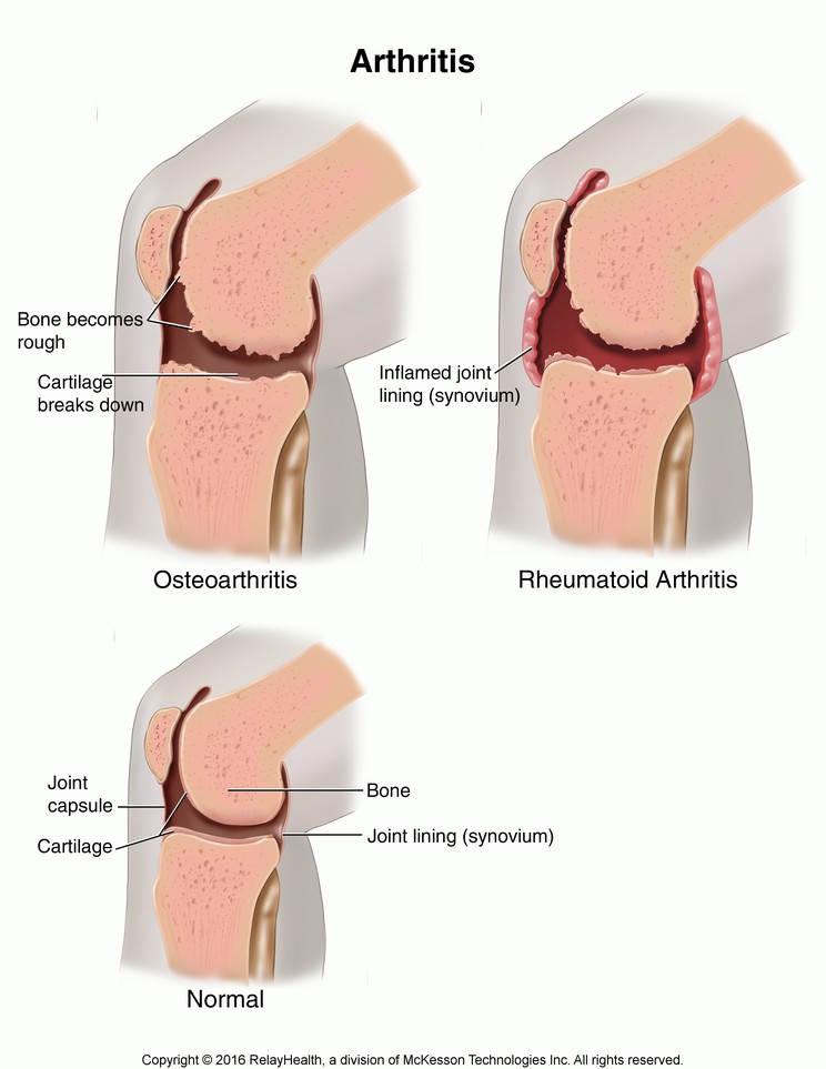 Arthritis: Illustration