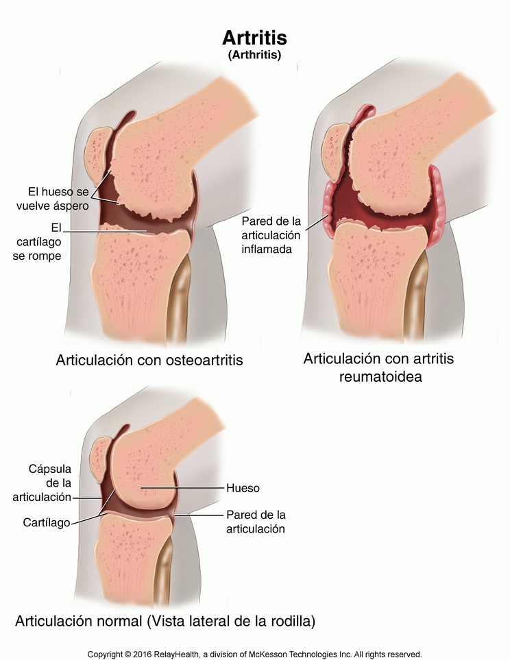 Arthritis: Illustration