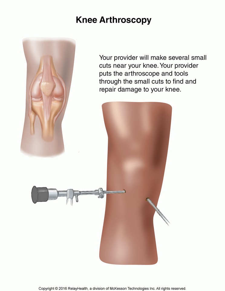 Knee Arthroscopy: Illustration