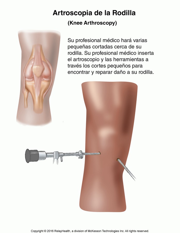Knee Arthroscopy: Illustration