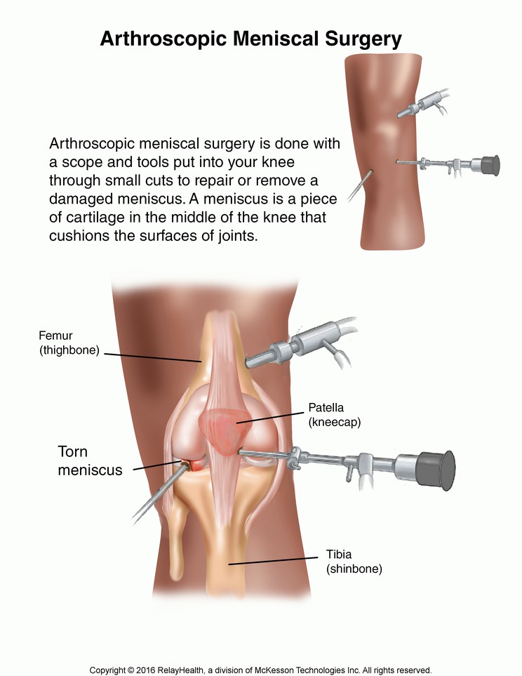 Arthroscopic Meniscal Surgery: Illustration