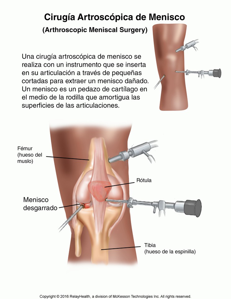 Arthroscopic Meniscal Surgery: Illustration