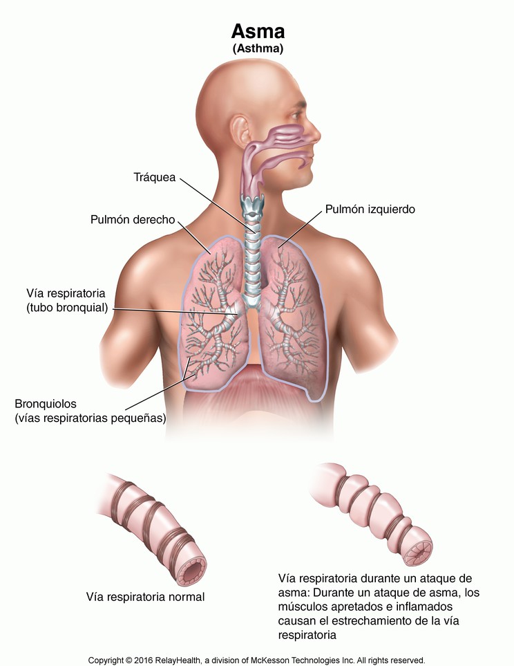 Asthma: Illustration
