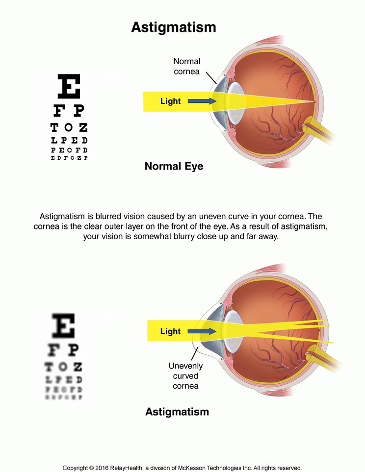 Astigmatism: Illustration