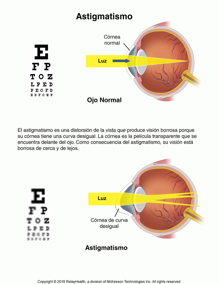 Astigmatism: Illustration