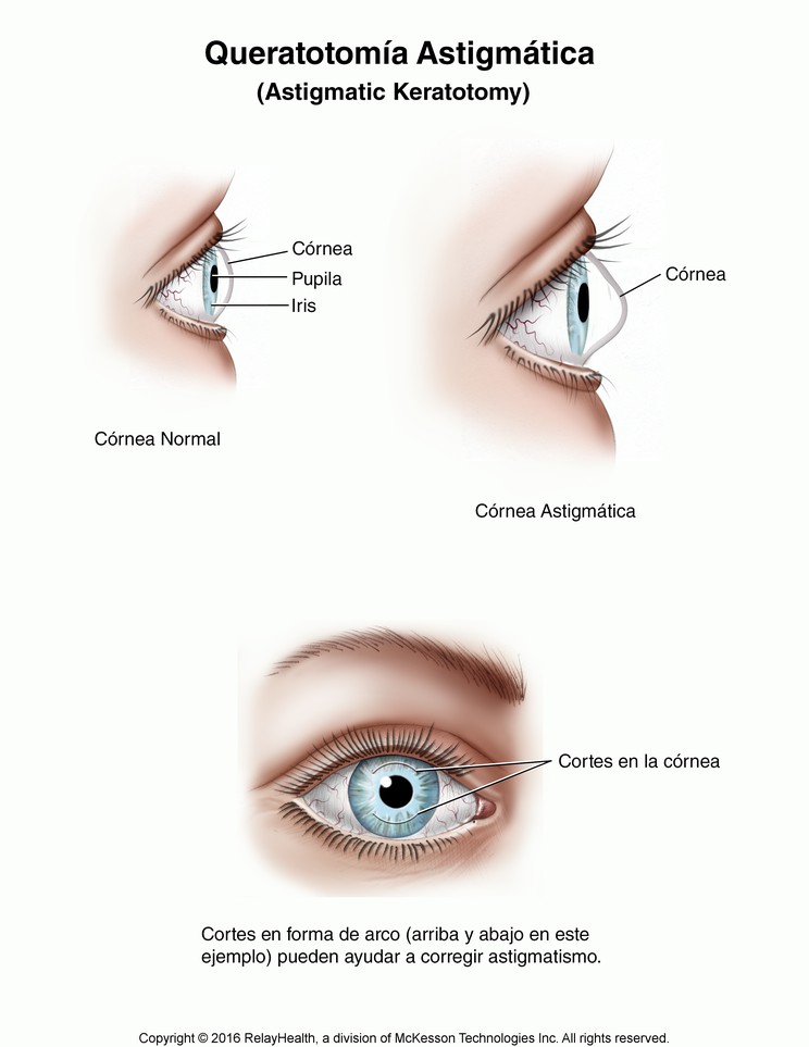 Astigmatic Keratotomy: Illustration