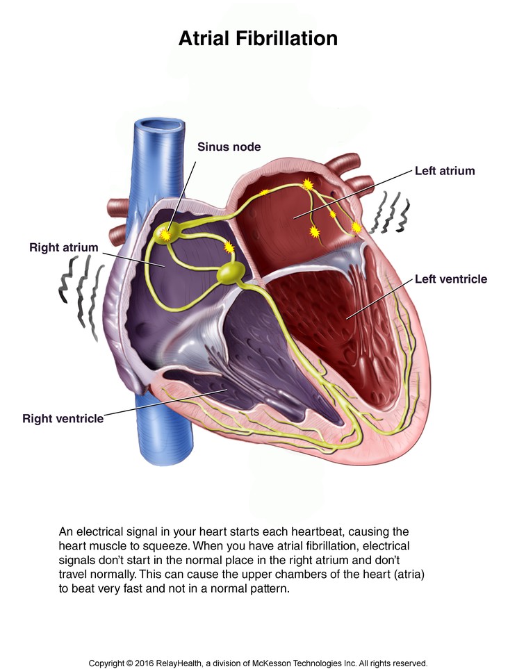 Atrial Fibrillation: Illustration