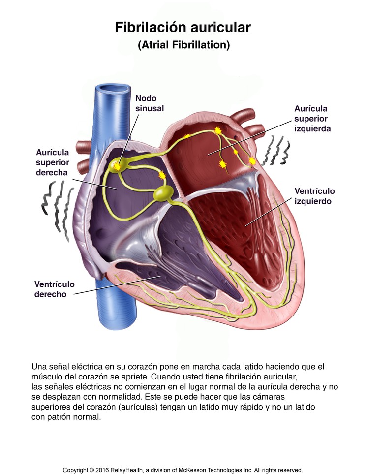 Atrial Fibrillation: Illustration