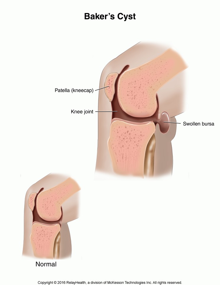 Baker's Cyst: Illustration