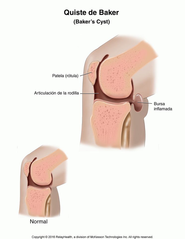 Baker's Cyst: Illustration