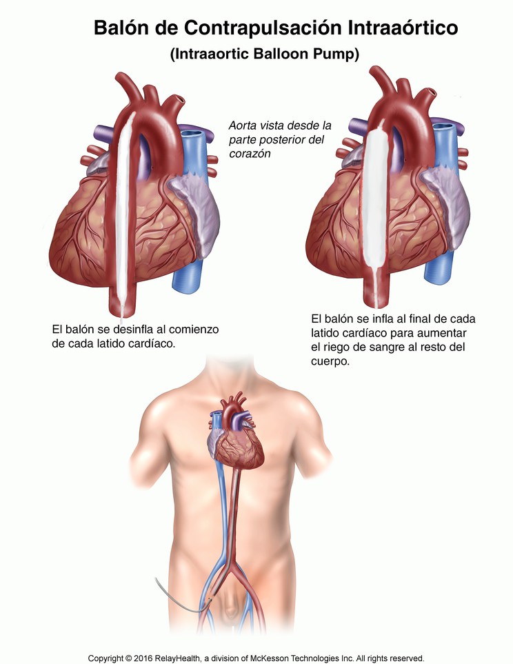 Intraaortic Balloon Pump: Illustration