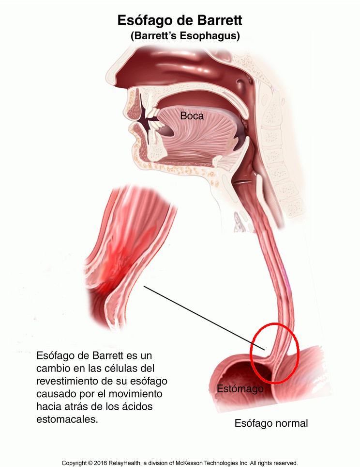 Barrett’s Esophagus: Illustration