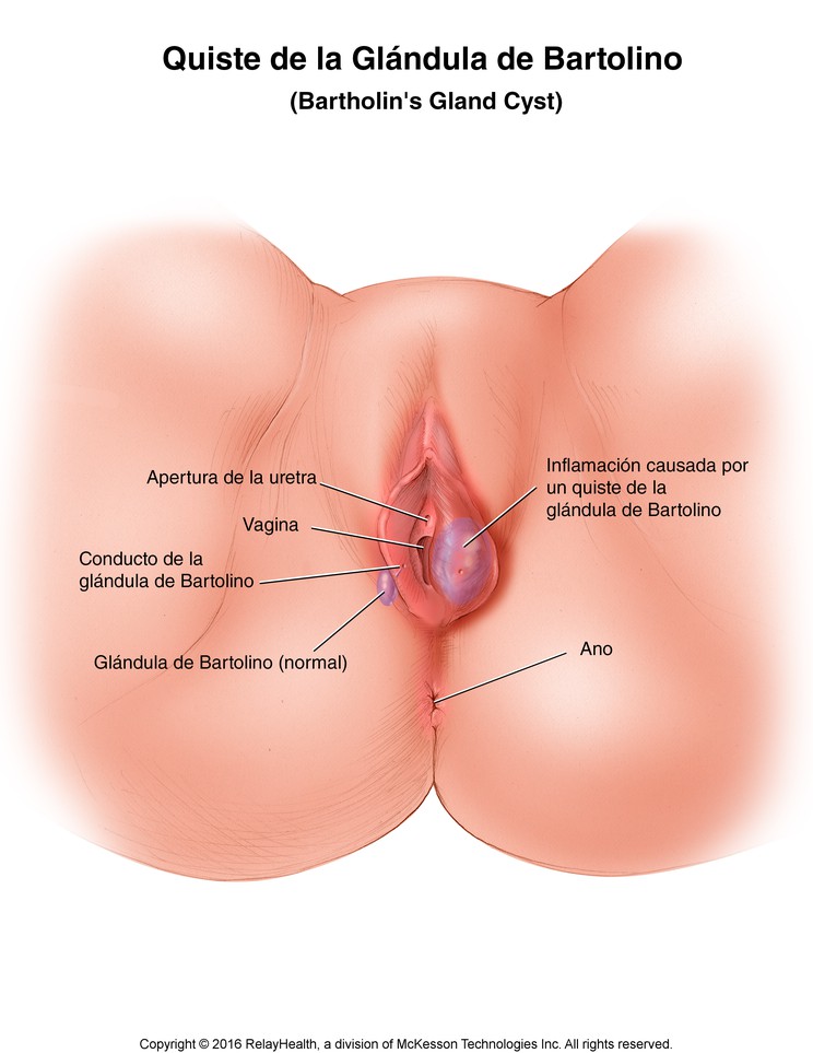 Bartholin's Gland Cyst: Illustration