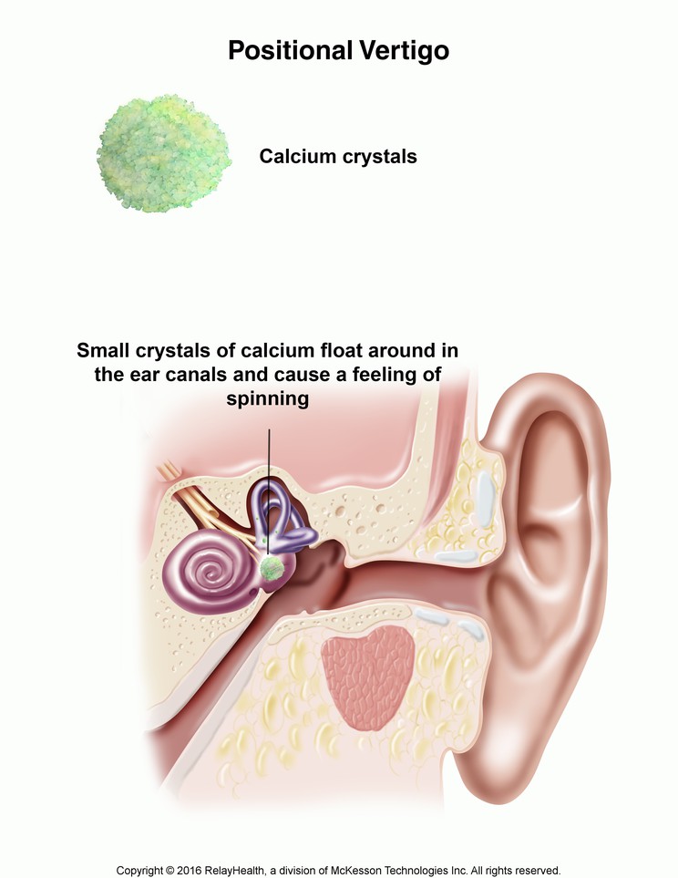 Positional Vertigo: Illustration