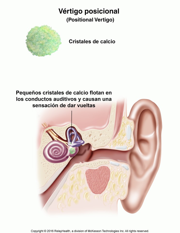 Positional Vertigo: Illustration