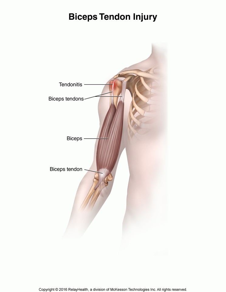 Biceps Tendon Injury: Illustration