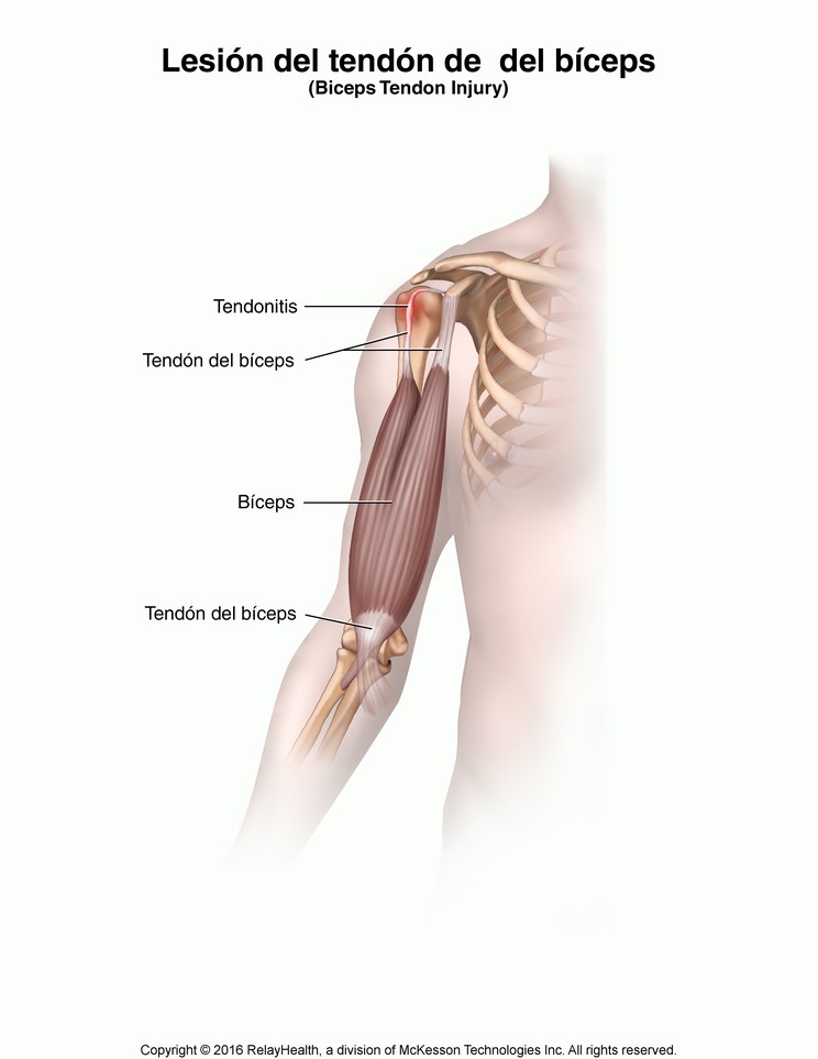 Biceps Tendon Injury: Illustration