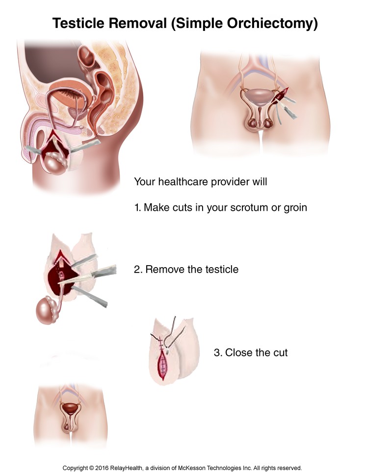 Testicle Removal: Illustration
