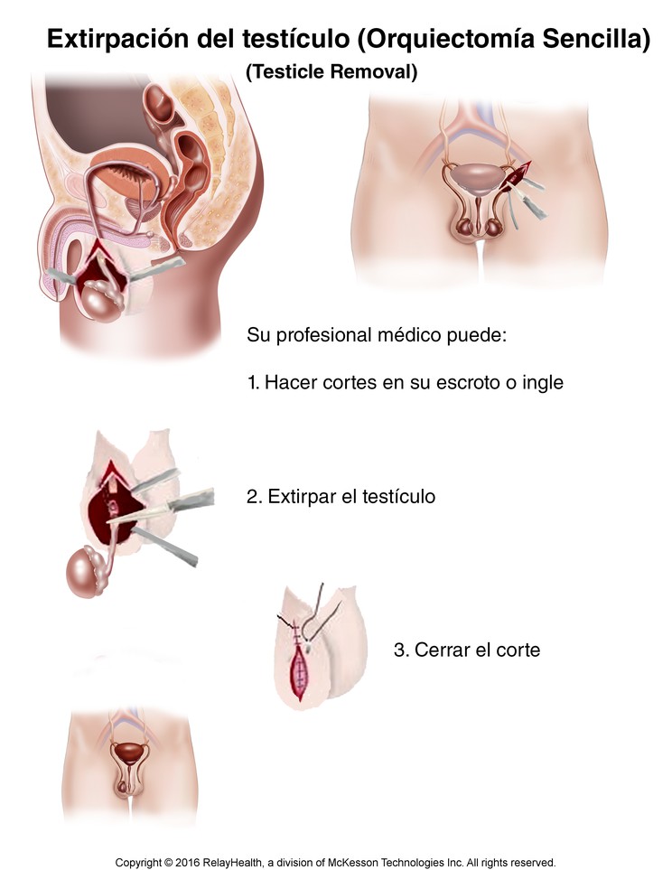 Testicle Removal: Illustration