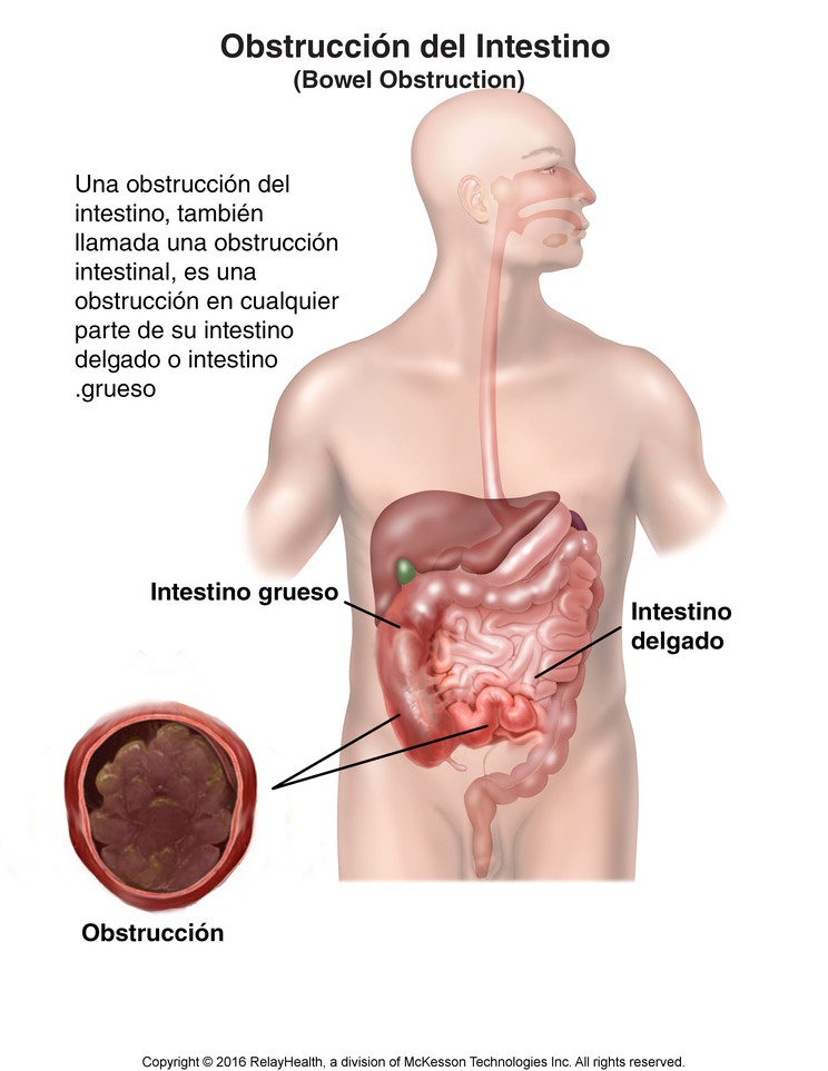Bowel Obstruction: Illustration