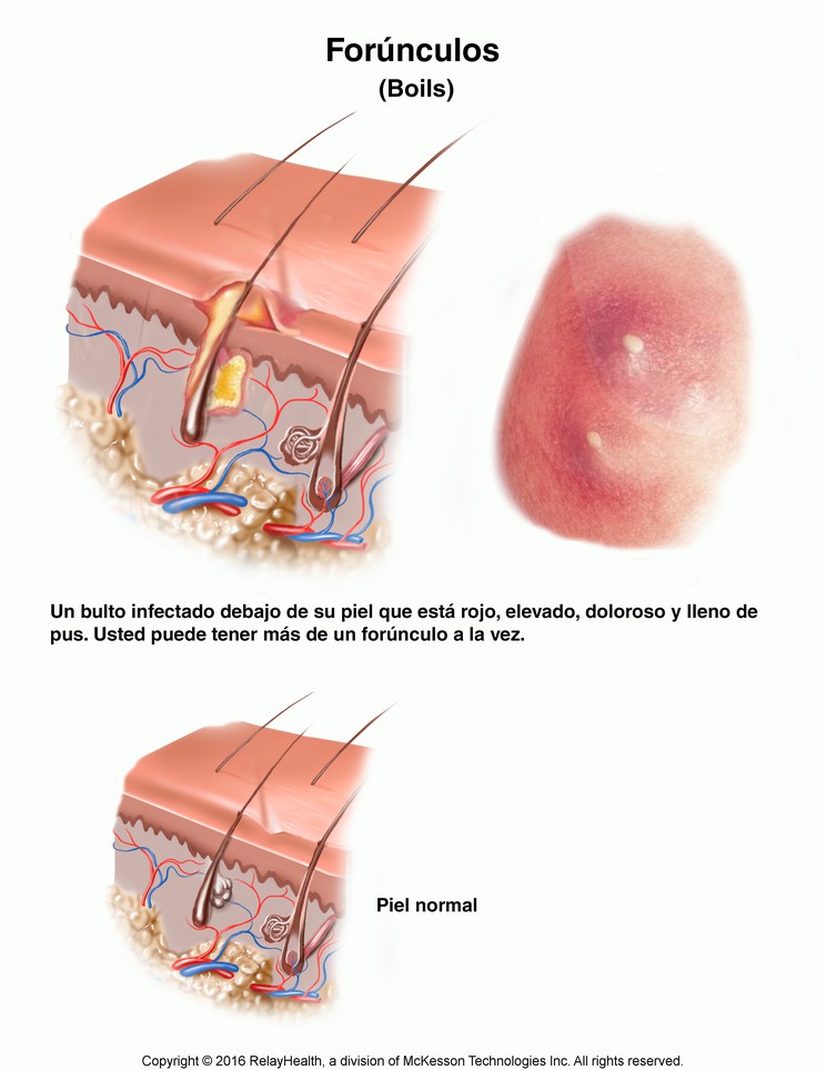 Boils: Illustration