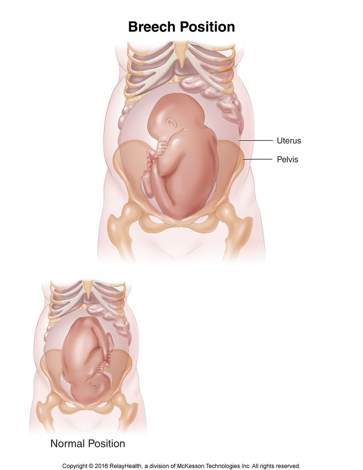 Breech Position: Illustration