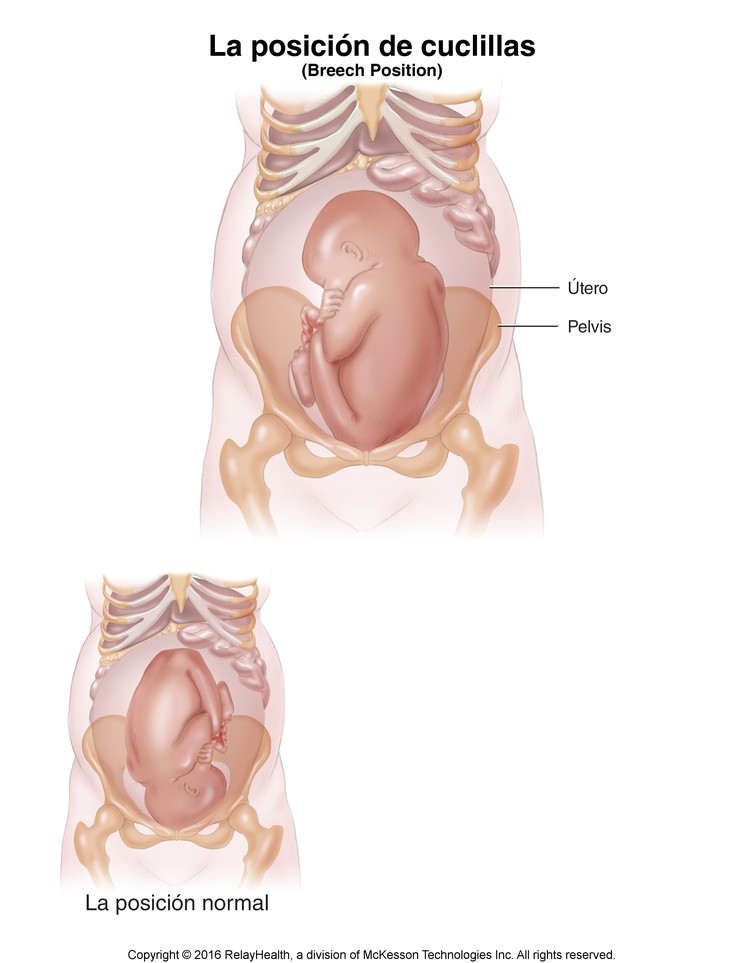 Breech Position: Illustration