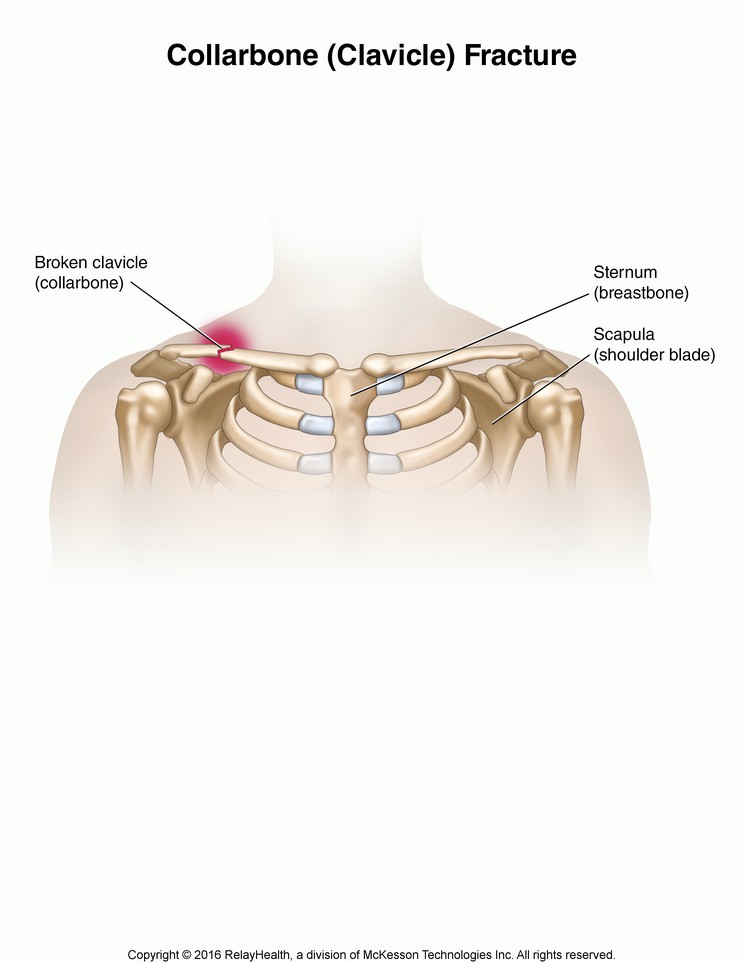 Collarbone (Clavicle) Fracture: Illustration