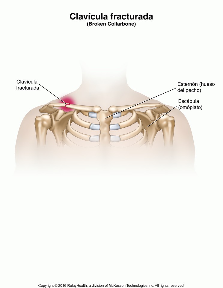 Collarbone Fracture: Illustration