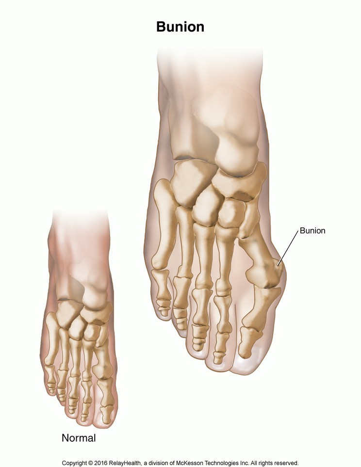 Bunion: Illustration