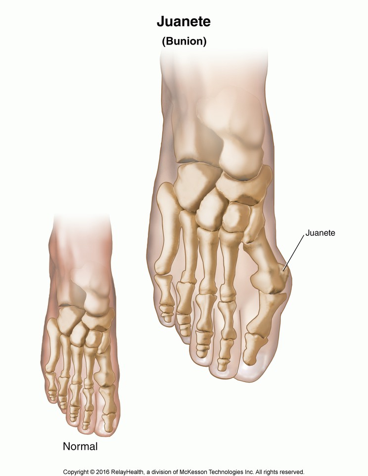 Bunion: Illustration
