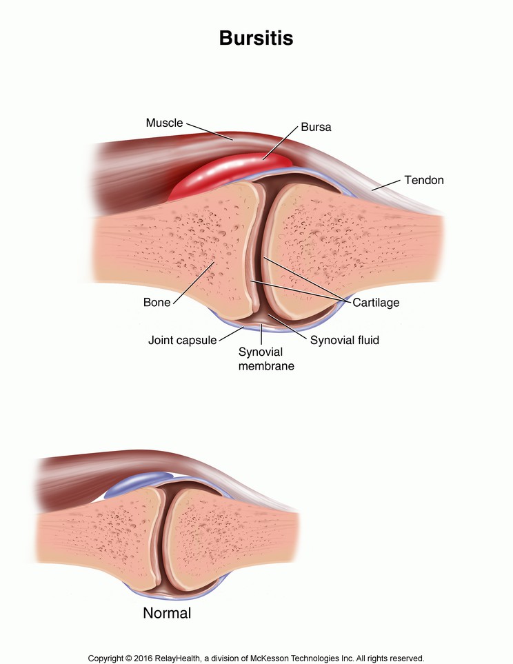 Bursitis: Illustration