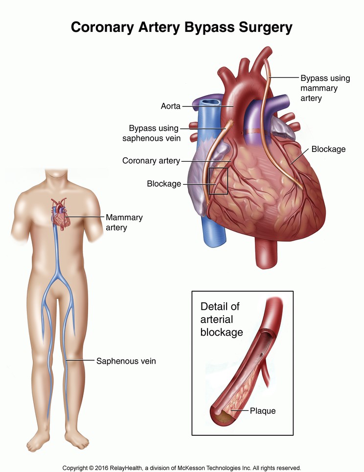 Coronary Artery Bypass Surgery: Illustration