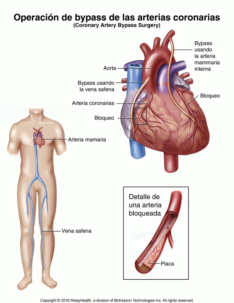 Coronary Artery Bypass Surgery: Illustration