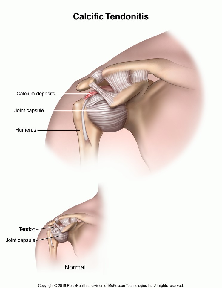 Calcific Tendonitis: Illustration