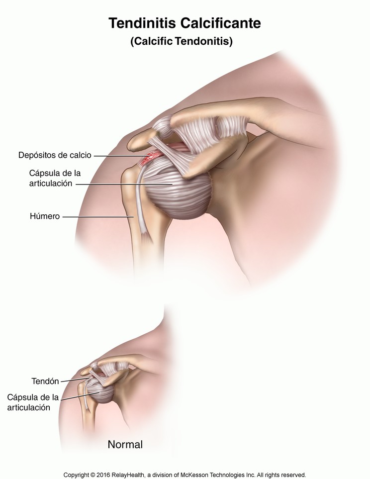 Calcific Tendonitis: Illustration
