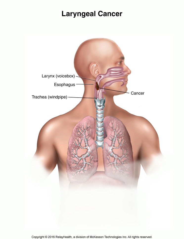Laryngeal Cancer: Illustration