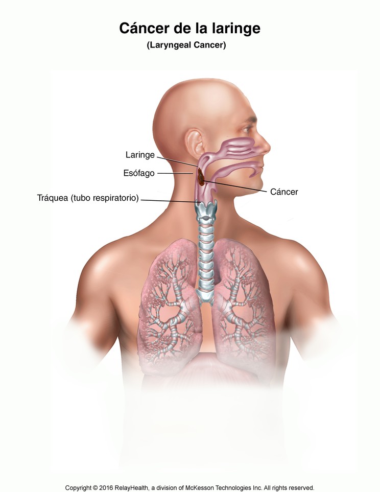 Laryngeal Cancer: Illustration