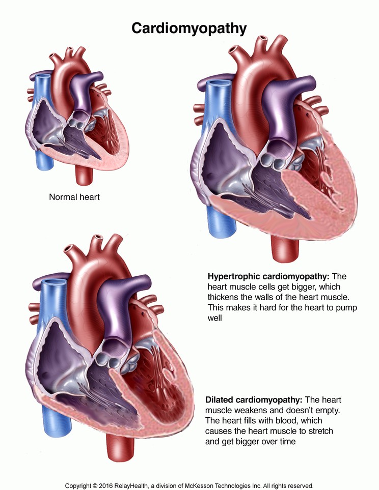 Cardiomyopathy: Illustration